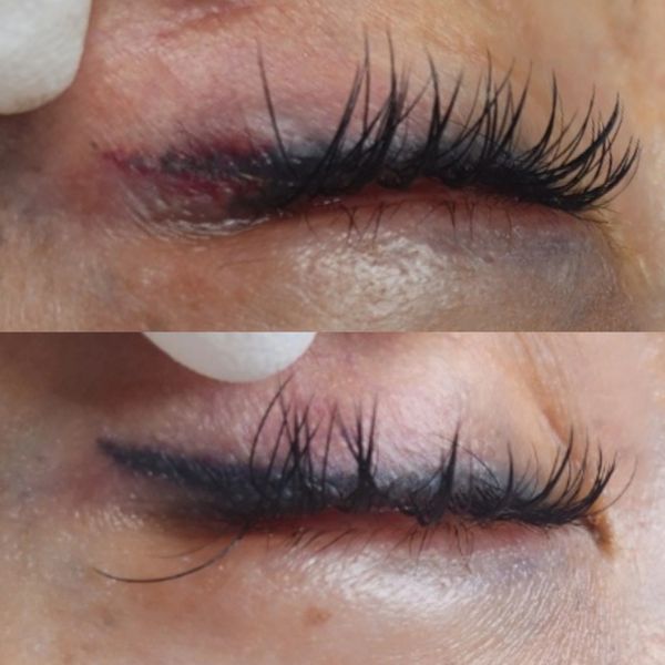 COSMETIC TATTOO REMOVAL Infinity Cosmetic Tattoo